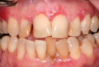 <p>What are common locations for erosive lichen planus?</p>