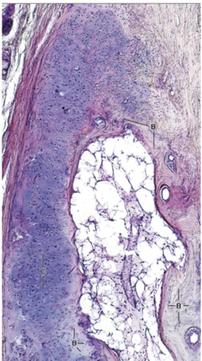 <p>What always happens to calcified cartilage?</p>
