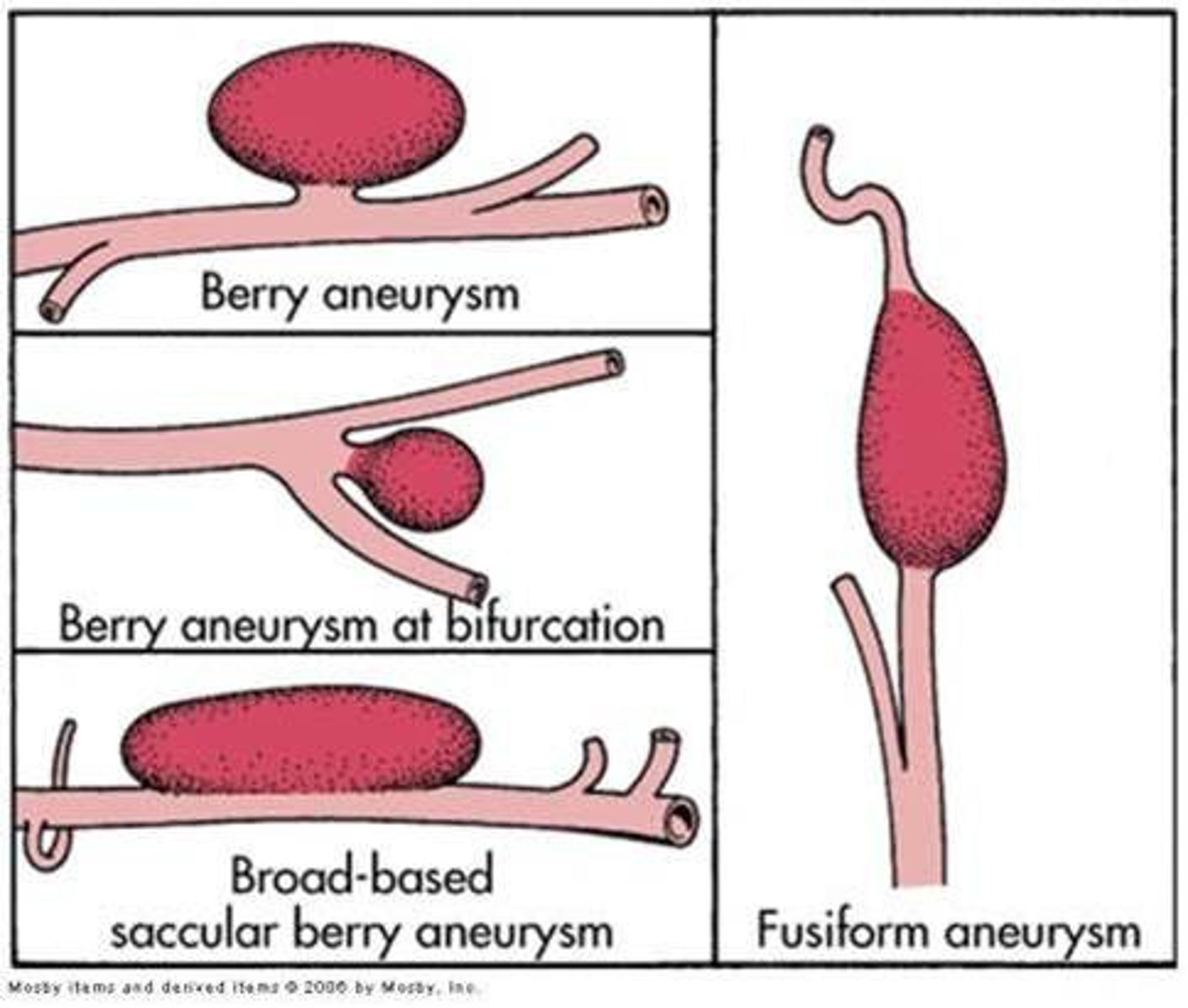 <p>bulging artery caused by a weakening in the arterial wall</p><p>- usually from atherosclerotic disease</p>