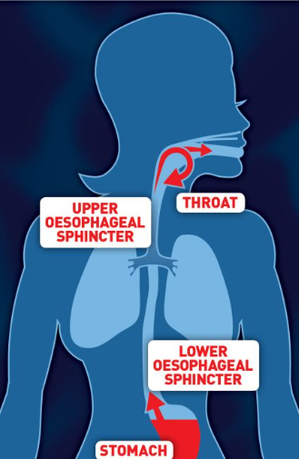 <p>• Gastro-oesophageal reflux (GORD) </p><p>• Laryngo-pharyngeal reflux (LPR) </p><p>• Stomach contents: acid, bile and pepsin</p><p>• GORD can irritate oesophageal lining and can lead to Barrett’s oesophagus. Dysfunction of lower oesophageal sphincter. </p><p>• LPR can irritate pharyngeal/laryngeal structures. Dysfunction in upper oesophageal sphincter.</p><p></p><p></p>