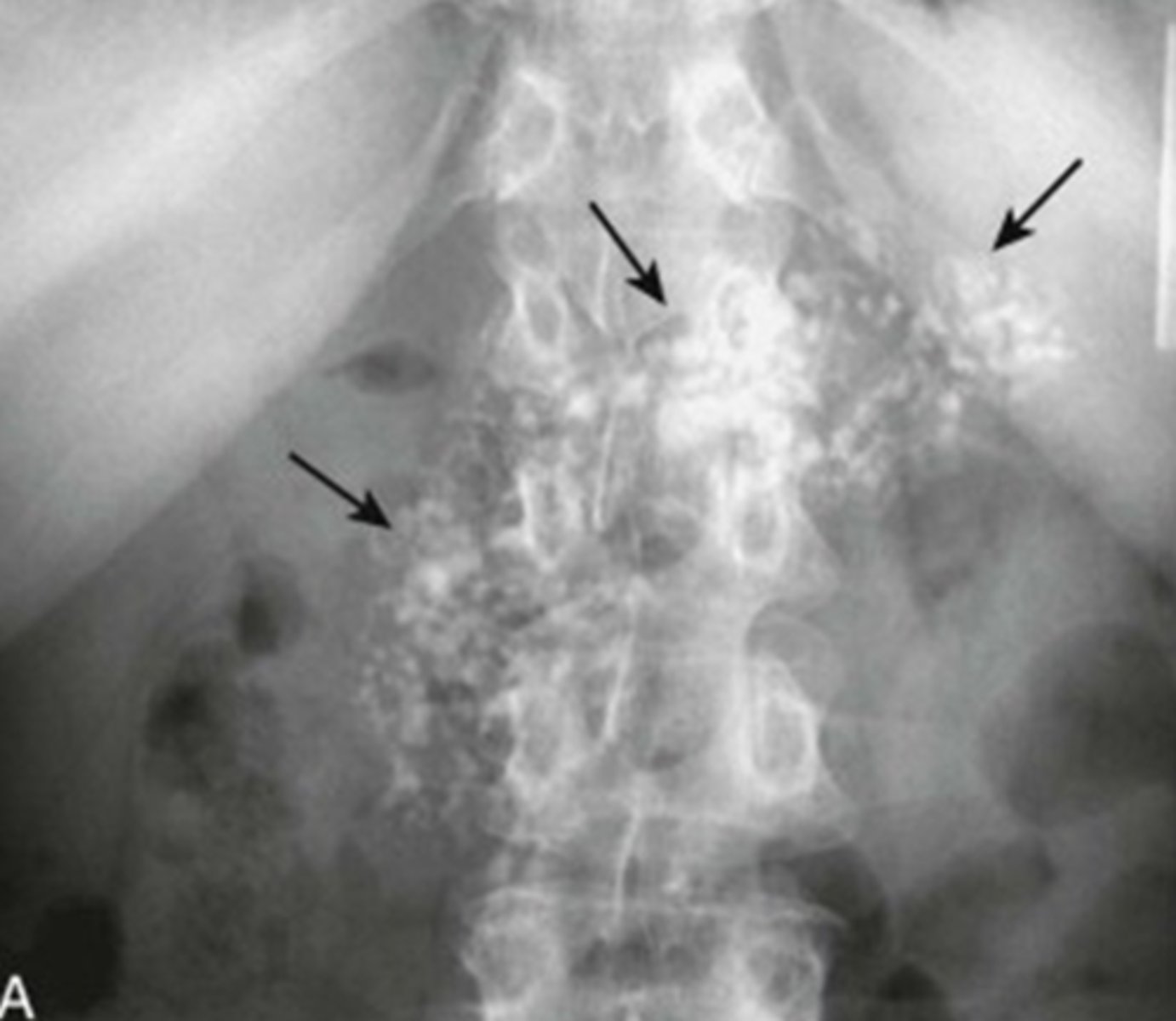 <p>calcification inside a solid organ or tumor</p>