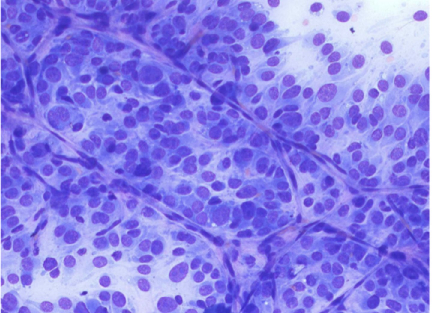 <p>You are examining a slide of a perivascular wall tumor. You note wispy cytoplasm, cells that break away from the sheet, and crown cells.</p><p>What is your top differential?</p>