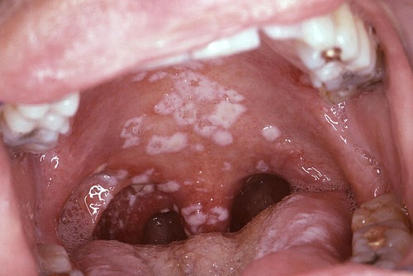 <p>A yeast infection of the mouth (thrush), throat, or vagina that can become a systemic infection in immunosuppressed individuals.</p>