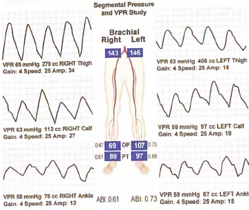 <p>Does the right calf VPR waveform in this report suggest any disease?</p>