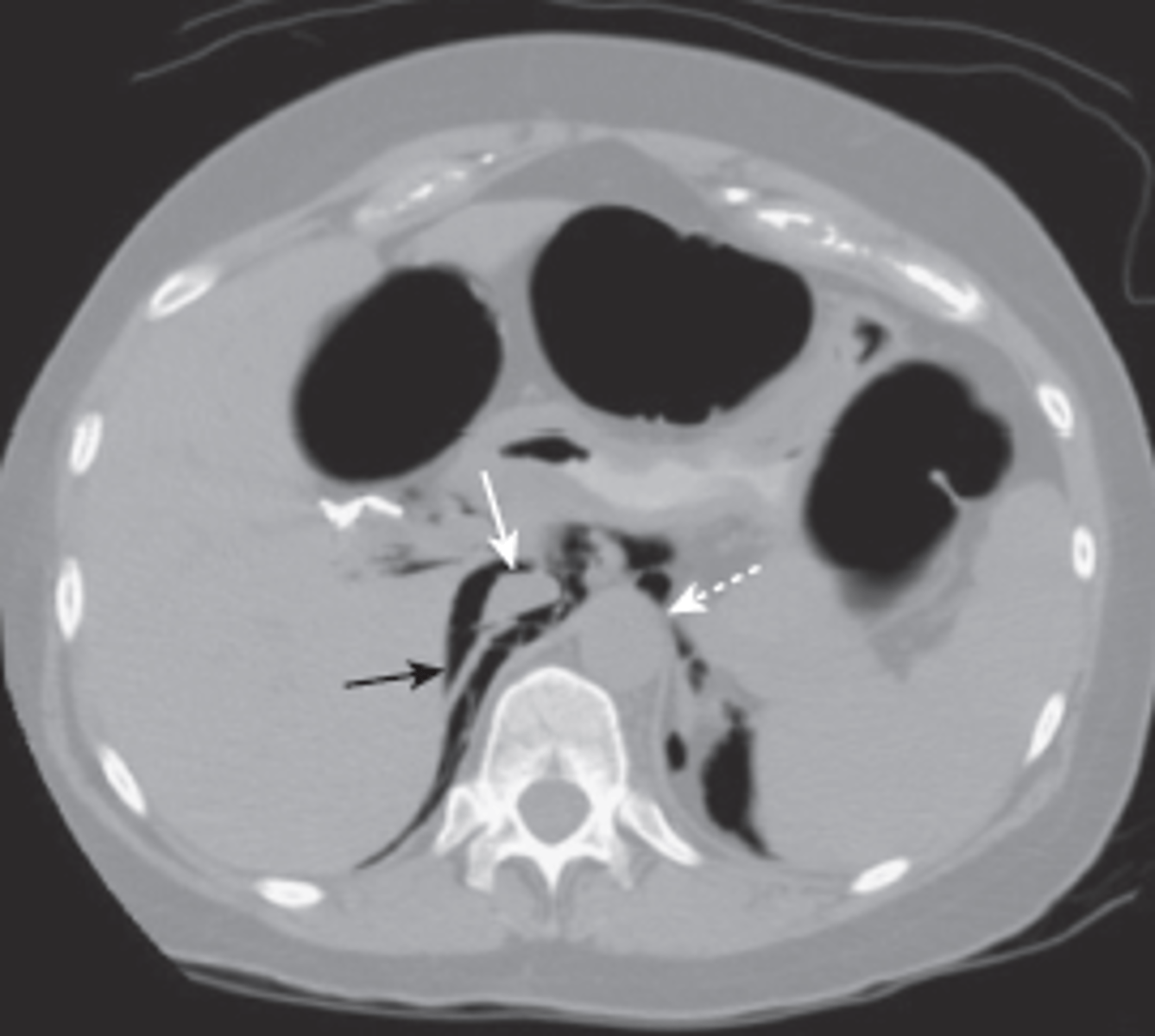 <p>air outside peritoneal cavity, same causes as intraperitoneal air</p><p>mostly seen on CT</p><p>streaky, linear appearance outlining extraperionteal structures, mottled blotchy appearance, relatively fixed position</p>