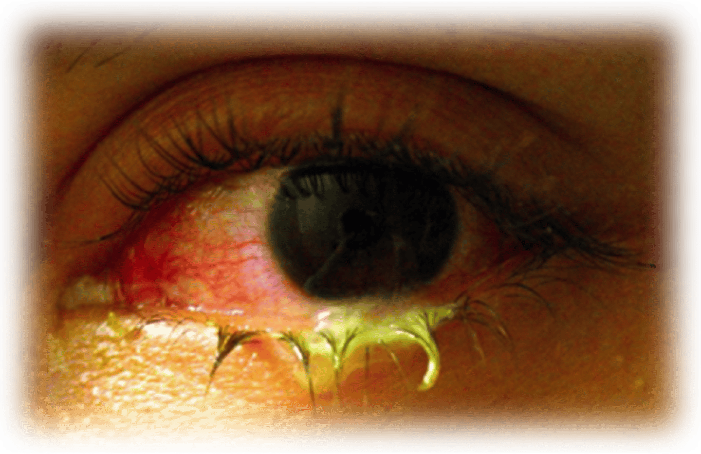<p>Pathogen: Neisseria gonorrhoeae</p><p>S+S: Inflammation of the conjunctiva, redness, purulent discharge; scarring if untreated</p><p>Transmission: Direct contact with an infected birth canal during delivery, finger-to-eye contact with infected genital secretions</p>