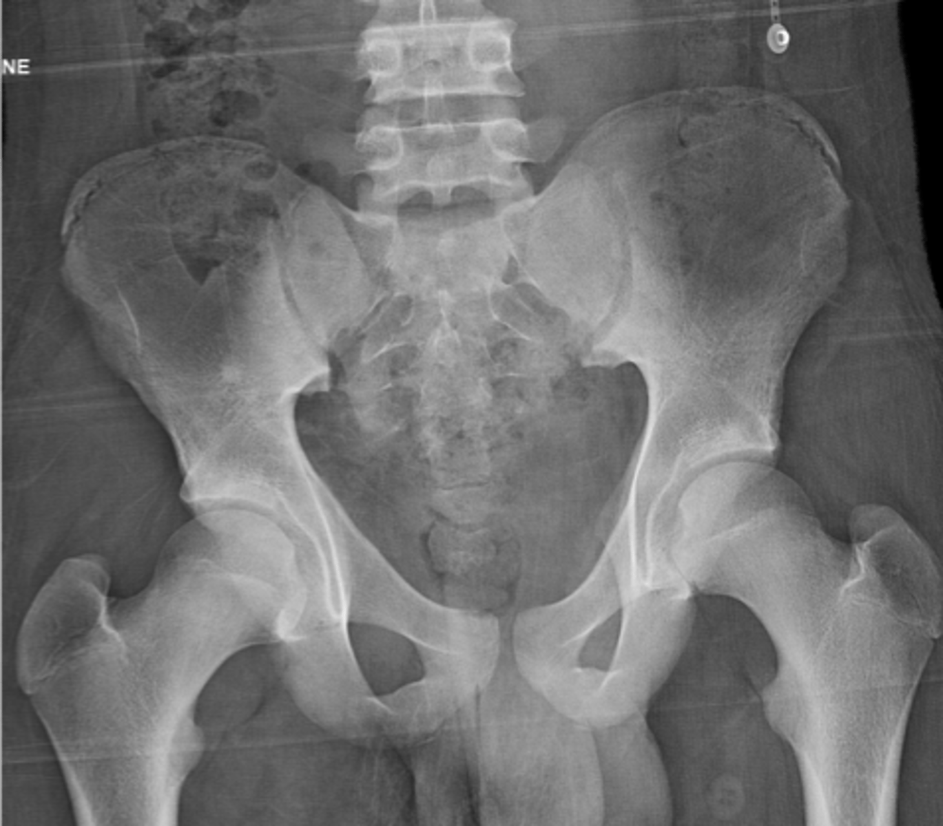 <p>What is the name for the iliac apophysis?</p>