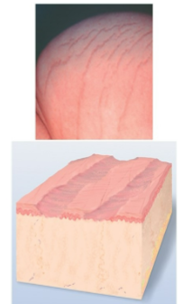 <p>resulting skin level is depressed w/ loss of tissue &amp; thinning</p>