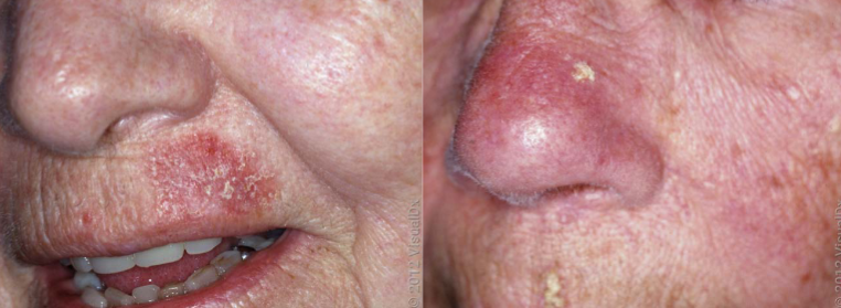 <p>actinic keratosis characteristics </p>
