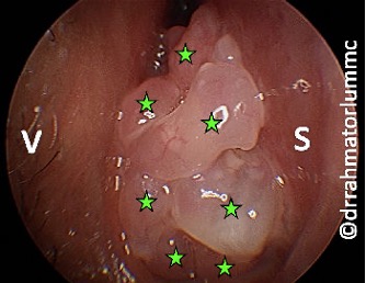 <p>unilateral nasal obstruction, hemorrhage, benign tumor on lateral nasal wall appears as cauliflower-like growth around middle meatus</p>