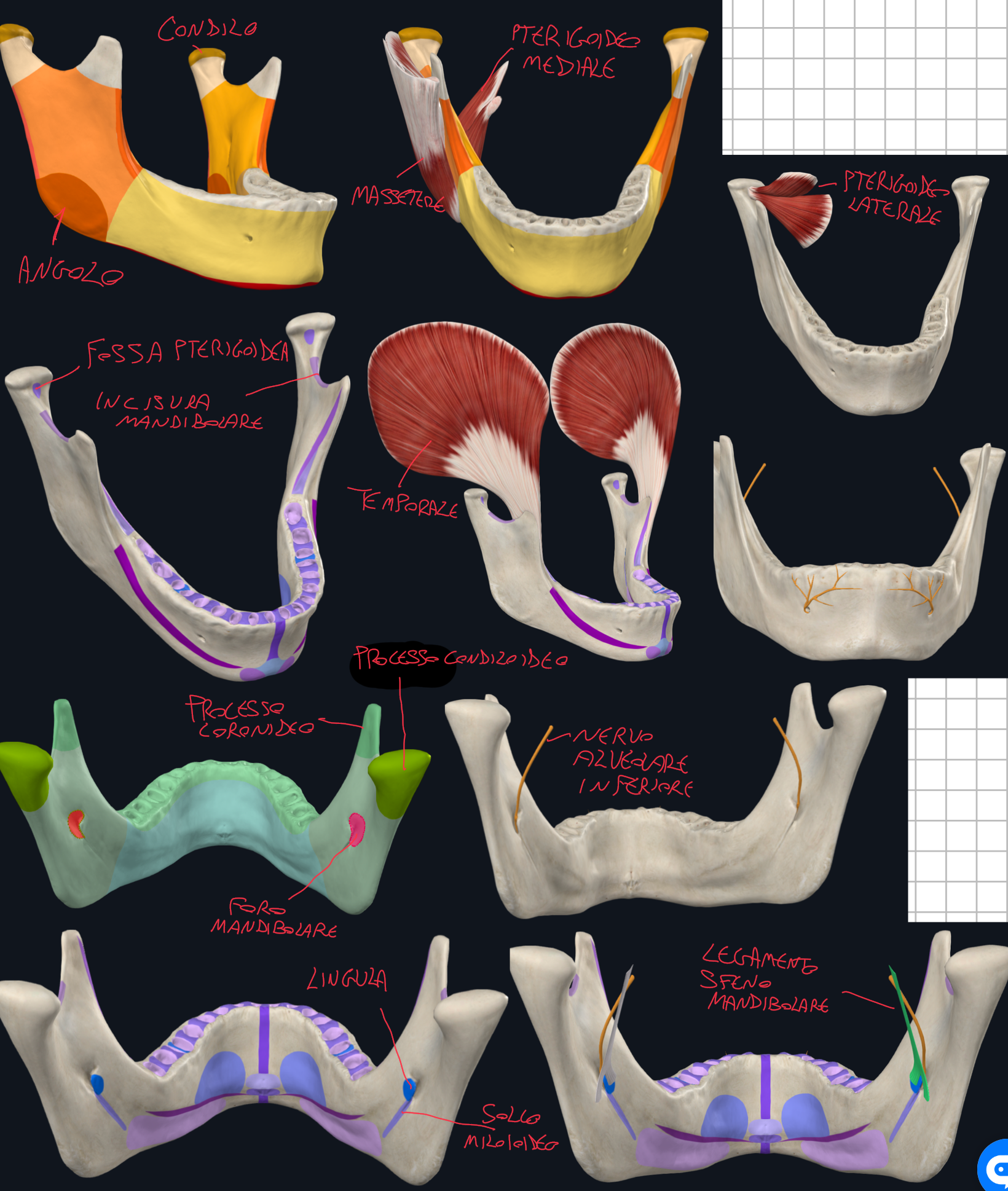 <p>Rami:</p><ul><li><p>Angolo della mandibola → tra corpo e ramo → presenta rugosità dovute all’inserzione di alcuni muscoli della masticazione:</p><ul><li><p>Sulla superficie laterale → Muscolo Massetere</p></li><li><p>Sulla superficie mediale → Muscolo Pterigoideo Mediale</p></li></ul></li><li><p>Processo Condiloideo, parte articolare:</p><ul><li><p>Condilo Mandibolare (testa)</p></li><li><p>Fossa Pterigoidea → inserzione muscolo pterigoideo laterale</p></li></ul></li><li><p>Processo Coronoideo → anteriormente → epifisi di trazione (cioè parte modellata) a causa dell’inserzione muscolo temporale</p></li><li><p>Incisura mandibolare → tra i due processi.</p></li><li><p>Foro Mandibolare:</p><ul><li><p>Si trova al centro della superficie mediale del ramo</p></li><li><p>E’ l’orifizio di entrata del canale mandibolare dove passa il nervo alveolare inferiore (ramo del mandibolare V3) → questo nervo invia rami ai denti dell’arcata inferiore → il canale termina con il foro mentale sulla superficie anteriore.</p></li><li><p>E’ protetto anteriormente da una sporgenza ossea → la Lingula</p></li></ul></li><li><p>Lingua Mandibolare:</p><ul><li><p>è inoltre un importante repere clinico per l’anestesia troncare del nervo alveolare inferiore (dentisti per l’anestesia per i denti inferiori)</p></li><li><p>è inoltre punto di inserzione del legamento sfenomandibolare che funge da perno per i movimenti dell’articolazione temporomandibolare.</p></li><li><p>Sotto abbiamo il solco miloioideo segnato dal passaggio del nervo e vasi omonimi.</p></li></ul></li></ul><p></p>