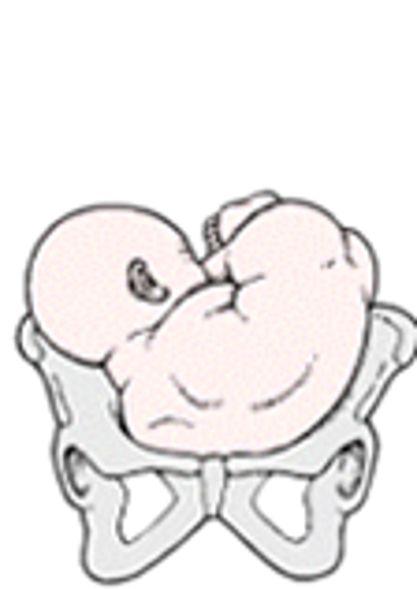 <p>baby is in transverse or horizontal position at delivery, must be turned</p>