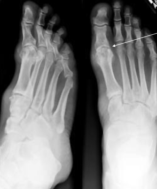 <p>What does this x-ray indicate?</p>