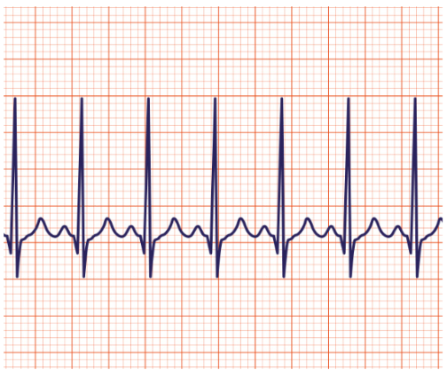 <p>what is the heartrate (round up) (9 small squares)</p>