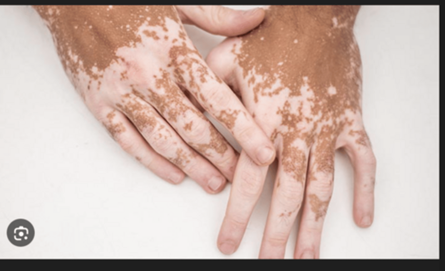 <p>- autoimmune dermatological disorder where there is loss of melanocytes</p><p>- occurs over time (not from birth)</p><p>- smooth falt patches of skin depigmentation</p>