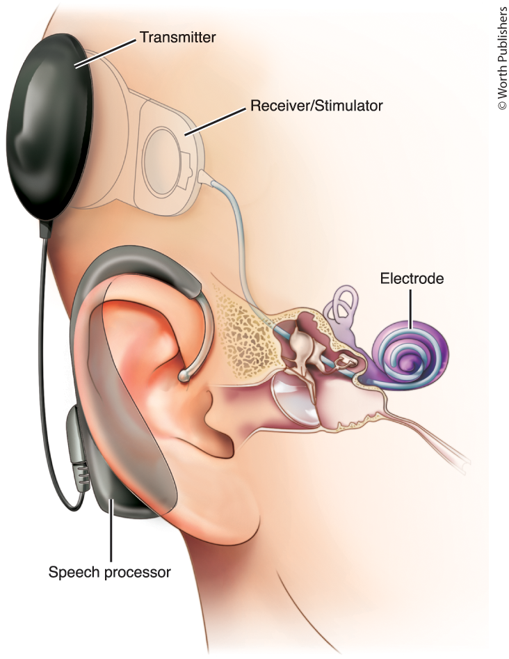 <p>Cochlear Implant</p>