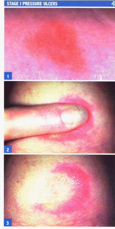 <ul><li><p>alteration of intact skin</p></li><li><p>redness or purple stage to skin</p></li><li><p>inc warmth or coolness</p></li></ul><p></p>