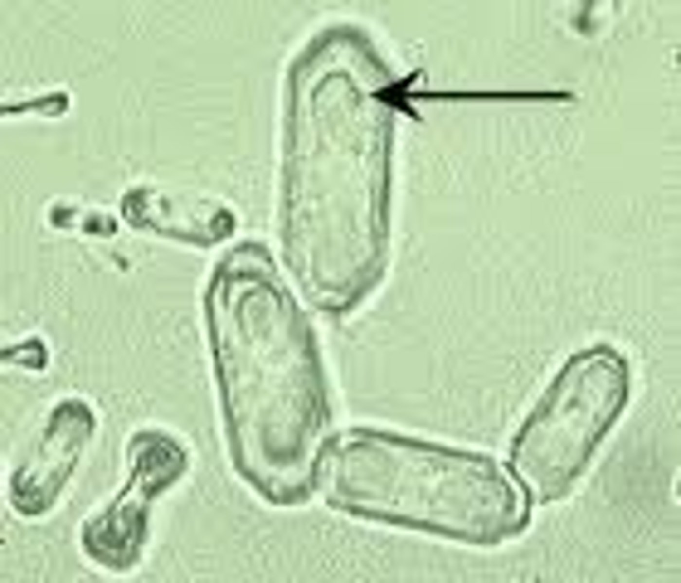 <p>- picket fence appearance</p><p>- indicates ethylene glycol poisoning</p>