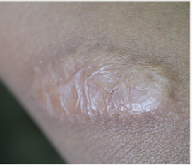 <p><strong>erythematous, thickened and raised within boundaries of original surgical incision that develops within a few weeks post surgery</strong></p><p>S/S: scar is <strong>firmer </strong>than healthy skin with <strong>broad and irregular surface after maturation,</strong> pain/pruritis common during healing </p>