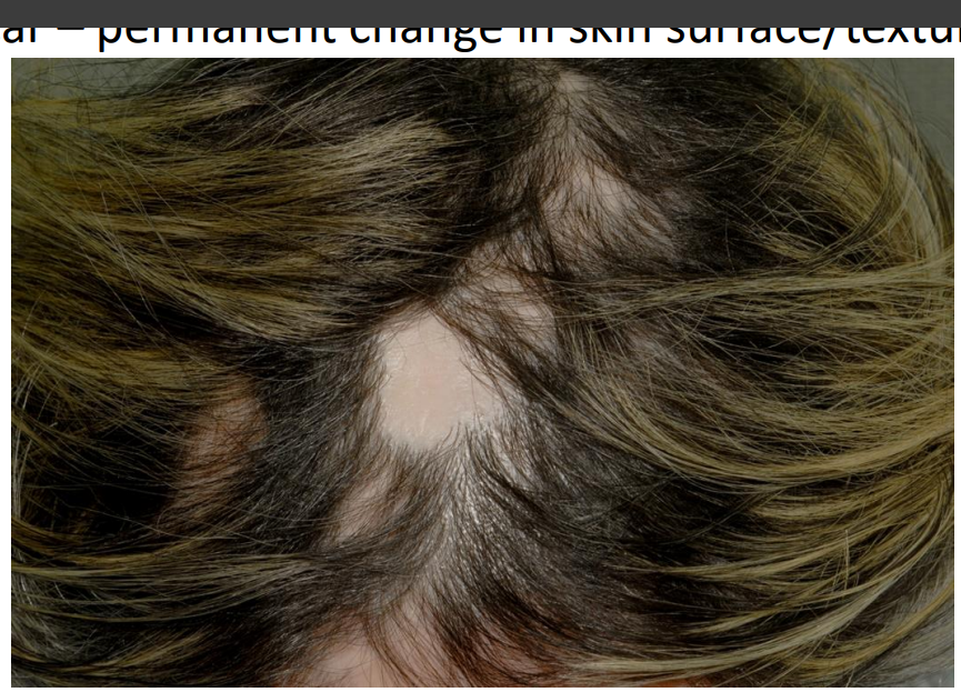 <p><strong>scar </strong></p><p><em>This patient has lichen planus in the scalp (lichen planopilaris showing patchy hair loss so called ‘footprints in the snow’)</em></p>