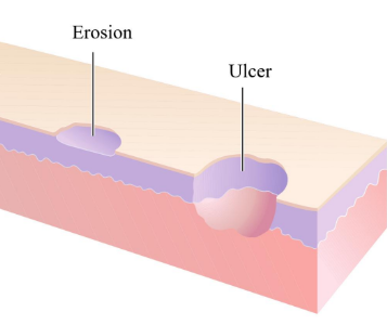 <p>Affect epidermis or epithelial lining (respiratory, GI or repro tracts)</p><ul><li><p>Erosion (necrosis of superficial layer of the epithelium)</p></li><li><p>Ulceration (full thickness necrosis)</p></li></ul><p></p>