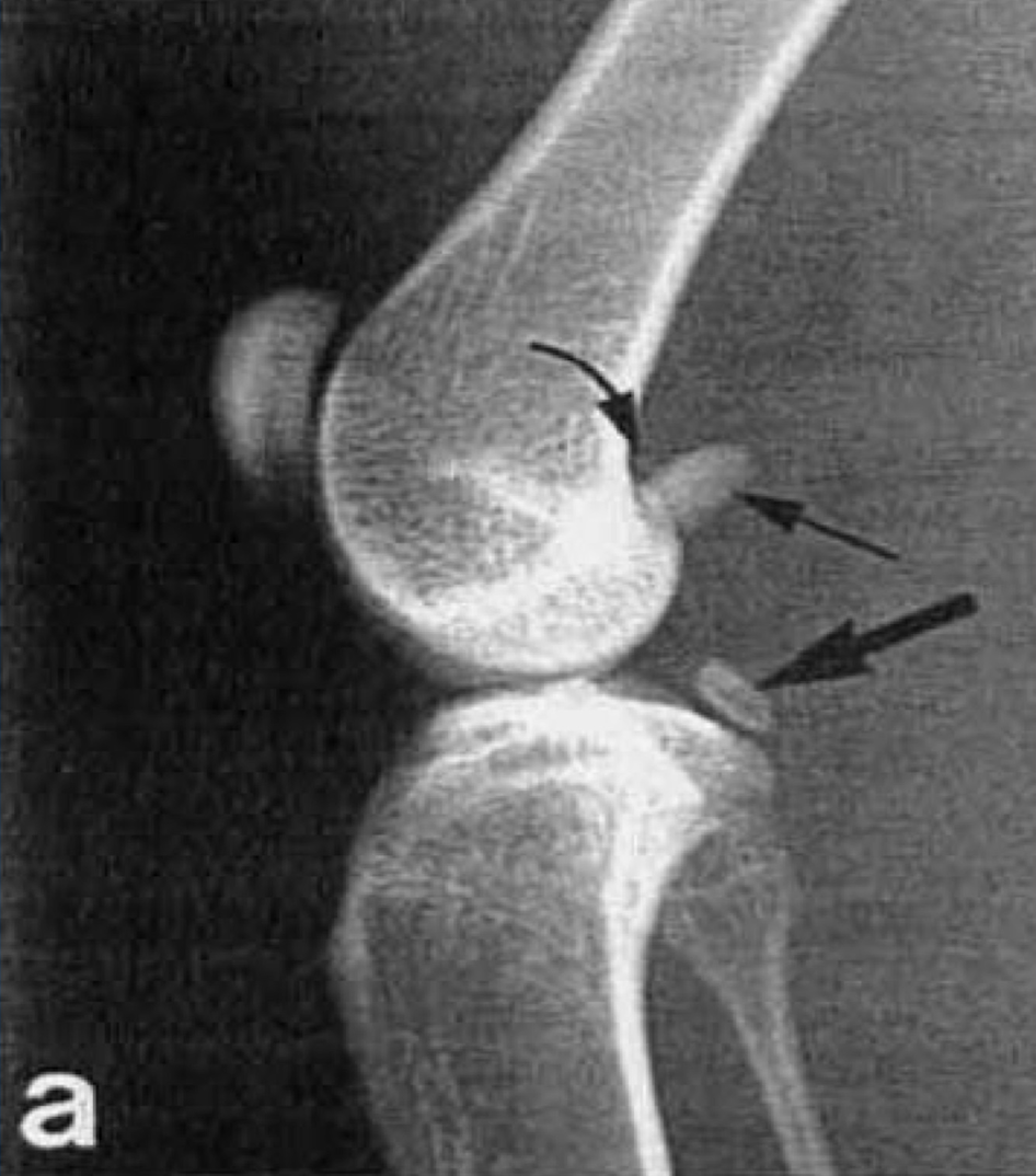 <p>sesamoid bones </p>
