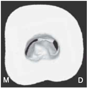 <p><span>A buccal, striplike dentin connection between the peninsula-like floor and the buccal wall of the pulp chamber that separates the C-shaped groove into mesial (M) and distal (D) orifices. </span></p><p><span>Sometimes the mesial orifice is separated into a mesiobuccal (MB) orifice and a mesio- lingual (ML) orifice by another striplike dentin connec- tion between the peninsula-like floor and the mesial wall of the pulp chamber (most common)</span></p>