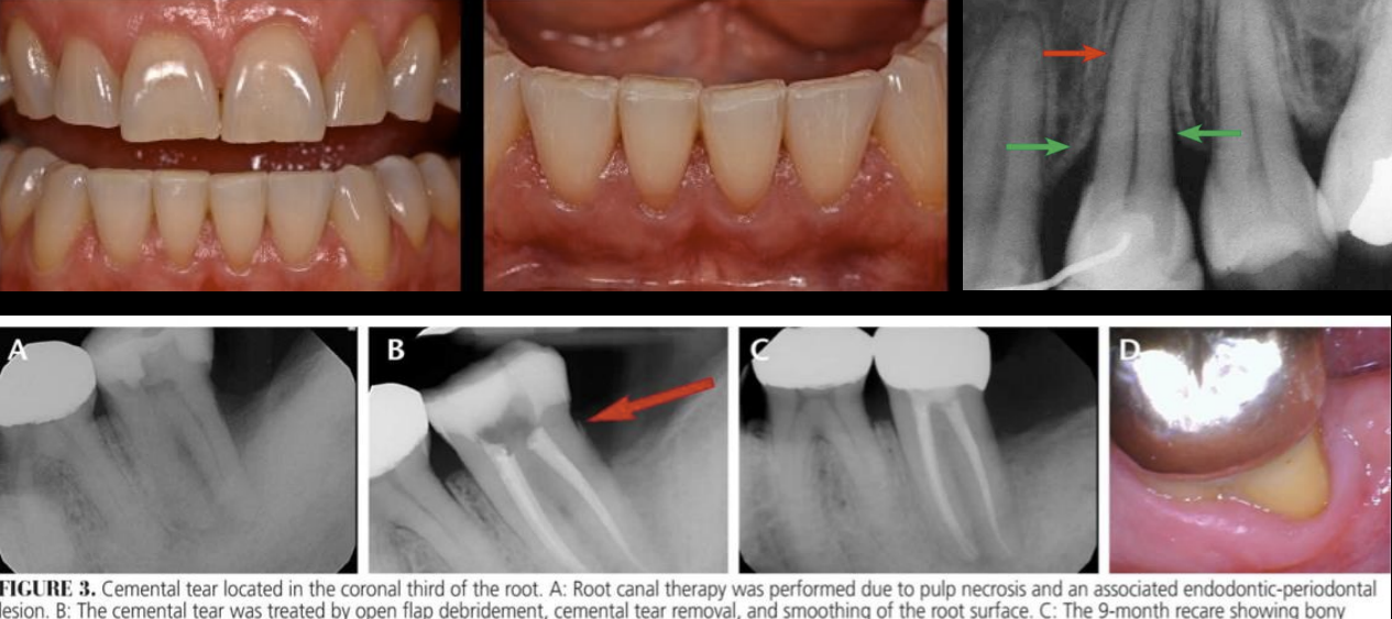 <ul><li><p>fremitus</p></li><li><p>Mobility</p></li><li><p>occlusal discrepancies</p></li><li><p>Wear facets</p></li><li><p>Tooth migration</p></li><li><p>Fracture</p></li><li><p>Thermal sensitivity</p></li><li><p>Discomfort when chewing</p></li><li><p>Widened PDL space</p></li><li><p>Root resorption</p></li><li><p>Cemental tear</p></li></ul><p></p>