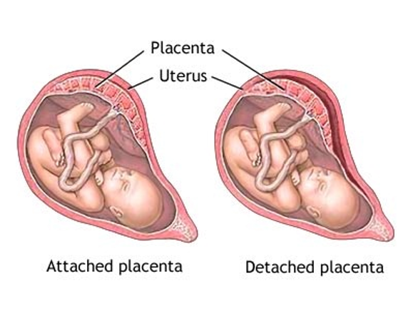 <ul><li><p>The premature separation of a normally implanted placenta from the uterine wall.</p></li><li><p>Mom is going to go in for an emergency C-Section</p></li></ul><p></p>