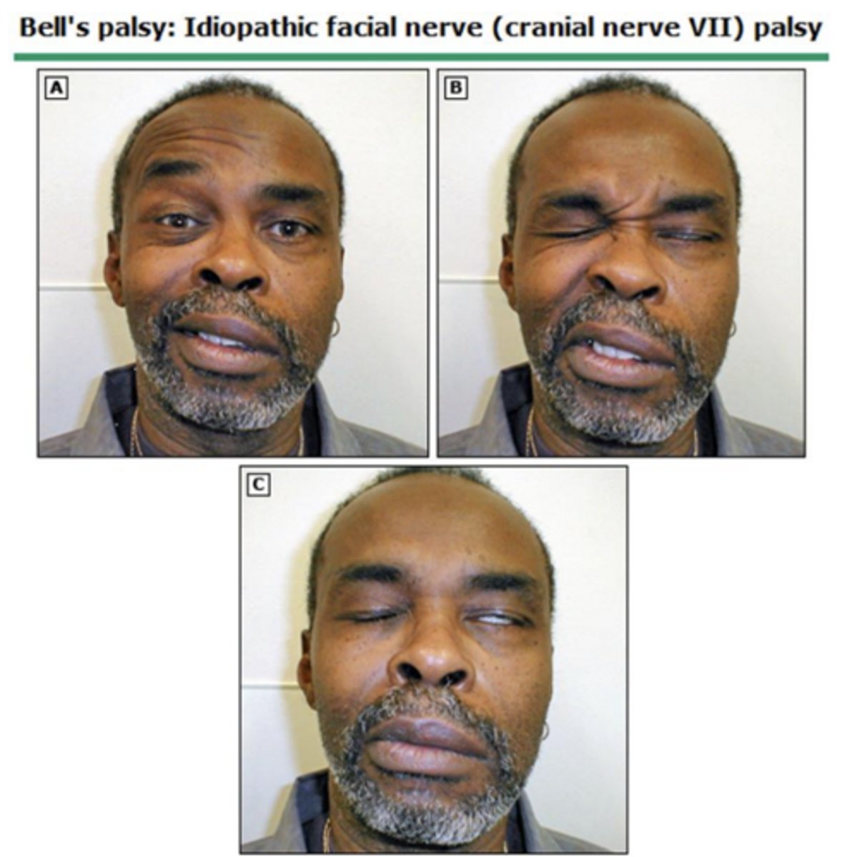 <p>Unilateral facial muscle paralysis, disappearance of facial creases/nasolabial fold, drooping corner of the mouth, and incomplete eye closure.</p>