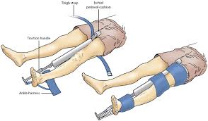 <p>applying a sager traction splint </p>