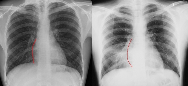 <p>Which structure forms the patents right cardiac border?</p>