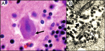 <p>Negri bodies under a microscope are indicative of what disease?</p>