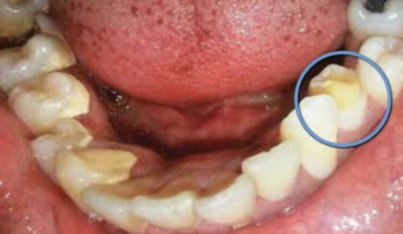 <p>Misvormingen kunnen ook ontstaan door een peri-apicale ontsteking of door een trauma van een melkelement. Als het melkelement ontstoken is geweest, kan het volgende element een glazuurafwijkingen krijgen. Dit noem <span><span>je </span><strong><span>turnertand&nbsp;</span></strong></span>(hierbij is vaak sprake van <span><strong><span>glazuurhypoplasie</span></strong></span>) Je kan dan zoals op dit plaatje een premolaar krijgen met een verstoorde ontwikkeling. Dit wordt een turnertand genoemd. Bij een diep carieus melkelement kan door uitbereiding van een pulpitis en door necrose een periapicale ontsteking ontstaan. Bij een melkmolaar ontstaat deze interradiculair. Door deze ontsteking kan de opvolger hypoplastisch worden. Een hypoplasie is een kwantitatief defect met als gevolg dat er meestal een reductie in de glazuurdikte is en het glazuur minder goed gevormd is. Er kunnen hele stukken glazuur ontbreken, maar ook rijen en kolommen gerangschikte putjes te zien zijn.</p>