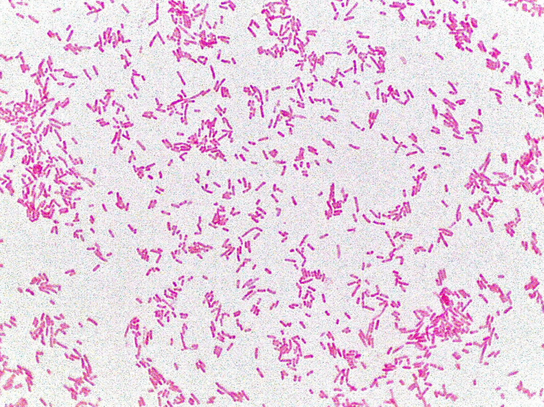 <p><strong>Lab differentiation:</strong><span>š©āā</span> <strong>Patient scenario:</strong><br>A 22-year-old woman presents with dysuria, frequency, and suprapubic pain. Urine culture shows <strong>pink colonies on MacConkey agar</strong>, oxidase-negative, and indole-positive. Diagnosis: <strong>urinary tract infection</strong> caused by this bacterium.</p><p><span>š</span> <strong>Details:</strong><br>(A) Classification: Gram-negative, facultative anaerobic rod.<br>(B) Disease: UTIs, neonatal meningitis, gastroenteritis (travelerās diarrhea, hemorrhagic colitis).<br>(C) Identification/Diagnosis: Gram stain, lactose fermentation on MacConkey agar, biochemical tests, PCR for virulence genes.<br>(D) Treatment/Prevention: UTIs treated with TMP-SMX, nitrofurantoin, or fluoroquinolones. Most diarrheal illnesses are self-limiting; avoid antibiotics in Shiga toxin strains (to prevent HUS). Prevention: hand hygiene, cook meat thoroughly.<br>(E) Unique Epidemiology & Lab Safety: Normal gut flora, but some strains acquire toxins (e.g., Shiga toxin). BSL-2 organism in labs; stool and urine cultures commonly used for identification.</p>