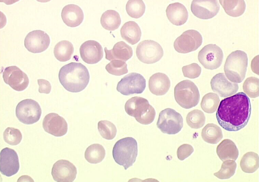* staining of retics (blue)
* Usually correlates to regenerative response