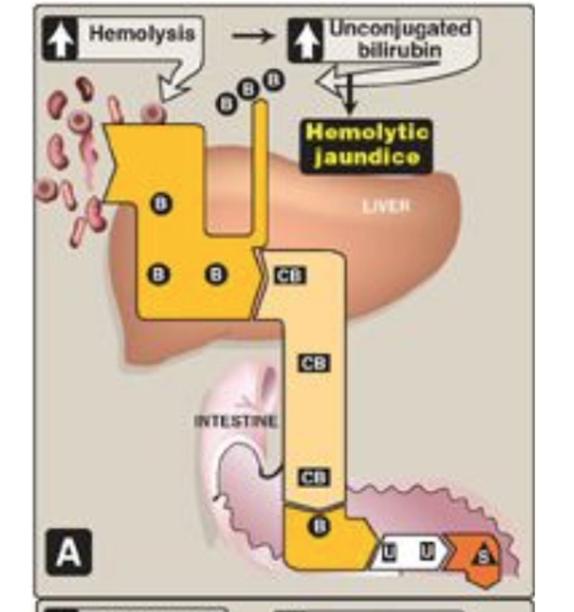 <p>-<strong>B and BG high</strong> in blood, <strong>conjugated and unconjugated hyperbilirubinemia</strong></p><p></p><p></p><p>lab test? <strong>HIGH DIRECT BILIRUBIN and TOTAL BILIRUBIN</strong></p><p><strong>AST/ALT may be high</strong>, not always (if liver problem will be high)</p><p></p><p>- results from obstruction in common bile duct (by cancer, gallbladder stone etc)</p><p>-pain in abdomen, pale/clay colored stool, BG high in urine</p><p></p><p>S: hyperbilirubinemia (liver regurgitates CB into bb), "urinary bilirubin" (CB eventually excrete into urine) </p><p></p><p>(B = bilirubin/ UCB) (CB/BG= conjugated bilirubin) (U= urobilinogen) (S= stercobilin; UDP = uridine diphosphate)</p>
