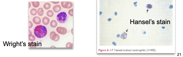 <ul><li><p class=""><strong>Not normally present</strong> in urine</p></li><li><p class="">Significant if <strong>&gt;1%</strong> of total WBCs</p></li><li><p class="">Visualized with <strong>Hansel’s</strong> or <strong>Wright’s stain</strong></p></li></ul><p class=""><strong>Associated with</strong>:</p><ul><li><p class=""><strong>Drug-induced interstitial nephritis</strong> (most common)</p></li><li><p class=""><strong>UTIs</strong></p></li><li><p class=""><strong>Parasitic infection</strong> (<em>Schistosoma</em>)</p></li><li><p class=""><strong>Renal transplant rejection</strong></p></li></ul><p></p>