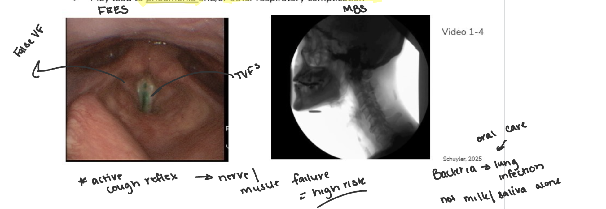 <ul><li><p>food, liquid, pill or secretions pass into airway below the level of the TRUE VFs</p></li><li><p>may lead to pneumonia and/or other respiratory complication </p></li></ul><p></p>