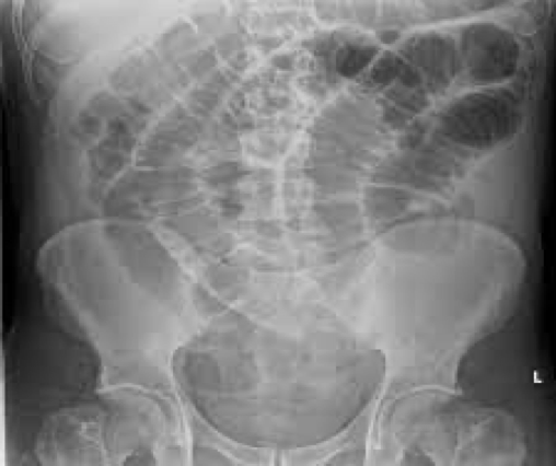 <p>Distended loops filled with gas</p><p>Bowel proximal to obstruction may be filled with fluid</p>