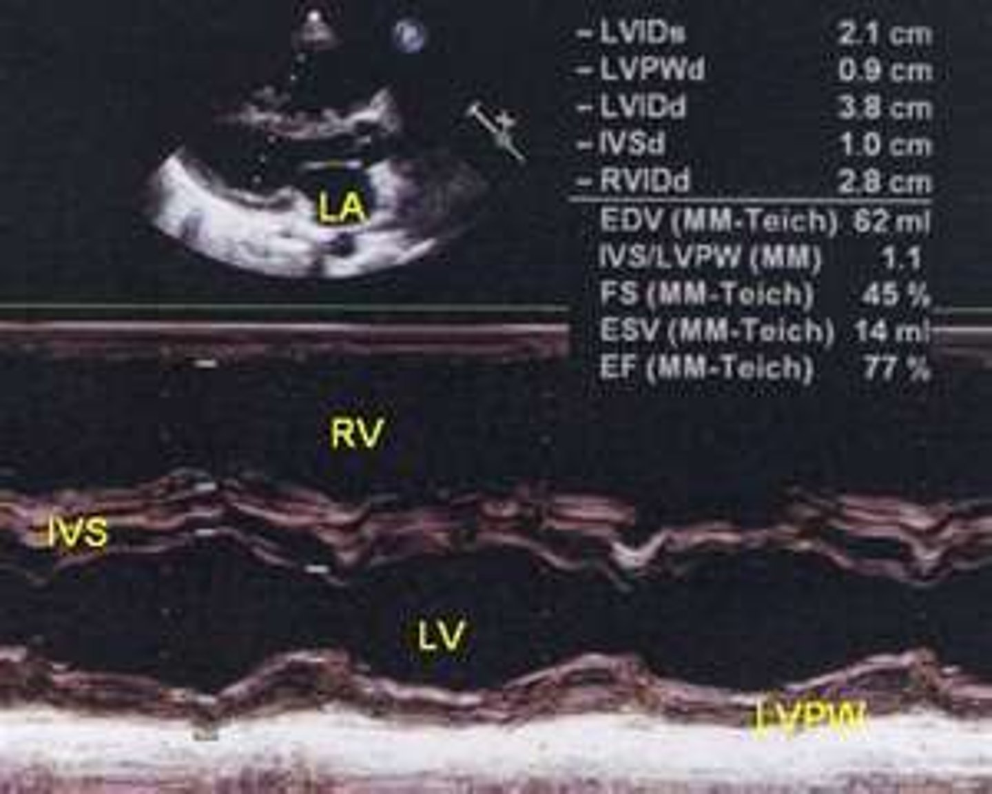 <p>consistent with dyskinetic wall motion and appears as D-shaped septum in PAP view</p>
