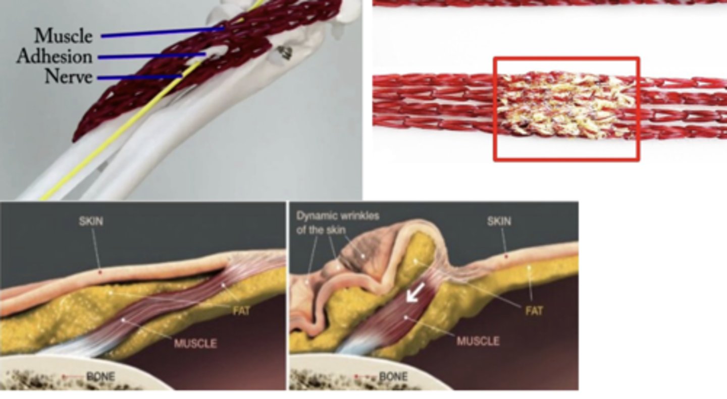 <p>Band of fibrous tissue that holds structures together abnormally</p><p>- Things won't move as smoothly/efficiently</p><p>- Rupture more likely for shortened muscles</p>
