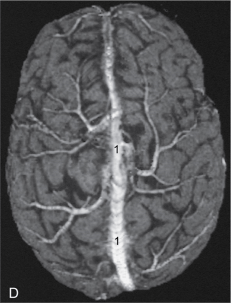 <p>What is the name of the structure here indicated by the #1:</p><p>A. Superior Sagittal Sinus</p><p>B. Transverse Sinus</p><p>C. Confluence of Sinuses</p><p>D. Middle Cerebral Artery</p><p>3 multiple choice options</p>