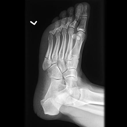 <p>transvere facture of the 5th metatarsal base.</p>