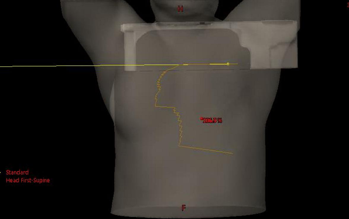 <p>What does the FLASH extending to the contralateral breast tell us about what we are treating?</p>