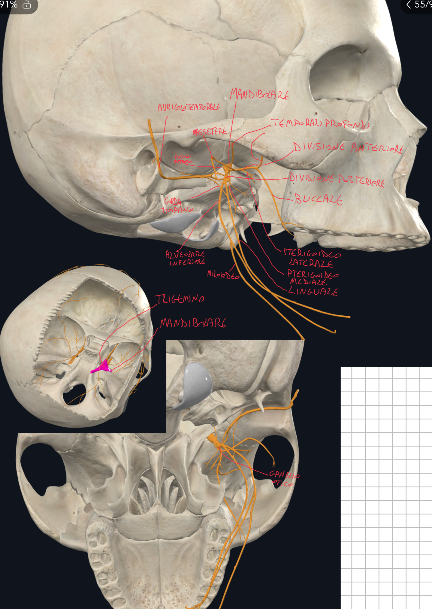 <p>Nervo Mandibolare (terza branca del trigemino, quinto nervo cranico):</p><ul><li><p>Esce dalla cavità cranica media attraverso il foro ovale per entrare nella fossa infratemporale dove si divide in due tronchi.</p></li></ul><p>Tronco Anteriore (prevalentemente motorio) con:</p><ul><li><p>Nervi Temporali Profondi (muscolo temporale)</p></li><li><p>Nervo del Massetere</p></li><li><p>Nervo Pterigoideo Laterale</p></li><li><p>Nervo Buccale → unico sensitivo (per mucosa guancia e cavità orale)</p></li></ul><p>Tronco Posteriore (prevalentemente sensitivo):</p><ul><li><p>Nervo Alveolare Inferiore → per denti inferiori, prima di entrare nel Canale Mandibolare emette un ramo, il Nervo Miloioideo che innerva il muscolo miloioideo e digastrico</p></li><li><p>Nervo Linguale → per 2/3 anteriori della lingua</p></li><li><p>Nervo Auricolotemporale → per cute tempia, padiglione auricolare, articolazione temporomandibolare.</p></li></ul><p>Prima della divisioni in Tronchi, dal Nervo Mandibolare parte:</p><ul><li><p>il Nervo Pterigoideo Mediale da cui partono fibre motorie che innervano il tensore del velo palatino e timpano</p></li></ul><p>Fibre Parasimpatiche collegate a V3:</p><ul><li><p>Che significa? Fibre parasimpatiche che nascono da altri nervi, usano il trigemino come “autostrada”&nbsp;per arrivare alle loro destinazioni.</p></li><li><p>Corda del Timpano (dal facciale, VII) → contiene fibre gustative speciali della lingua e fibre parasimpatiche pregangliali che con sinapsi passano il segnale a fibre postgangliari per le ghiandole sottolinguali e sottomandibolari</p></li><li><p>Nervo Piccolo Petroso (dal glossofaringeo, IX) → contiene fibre parasimpatiche pregangliari per neuroni del ganglio ottico con le quali formano sinapsi → così, fibre postgangliari continuano con il Nervo Auricolotemporale per innervare la parotide.</p></li></ul><p></p>