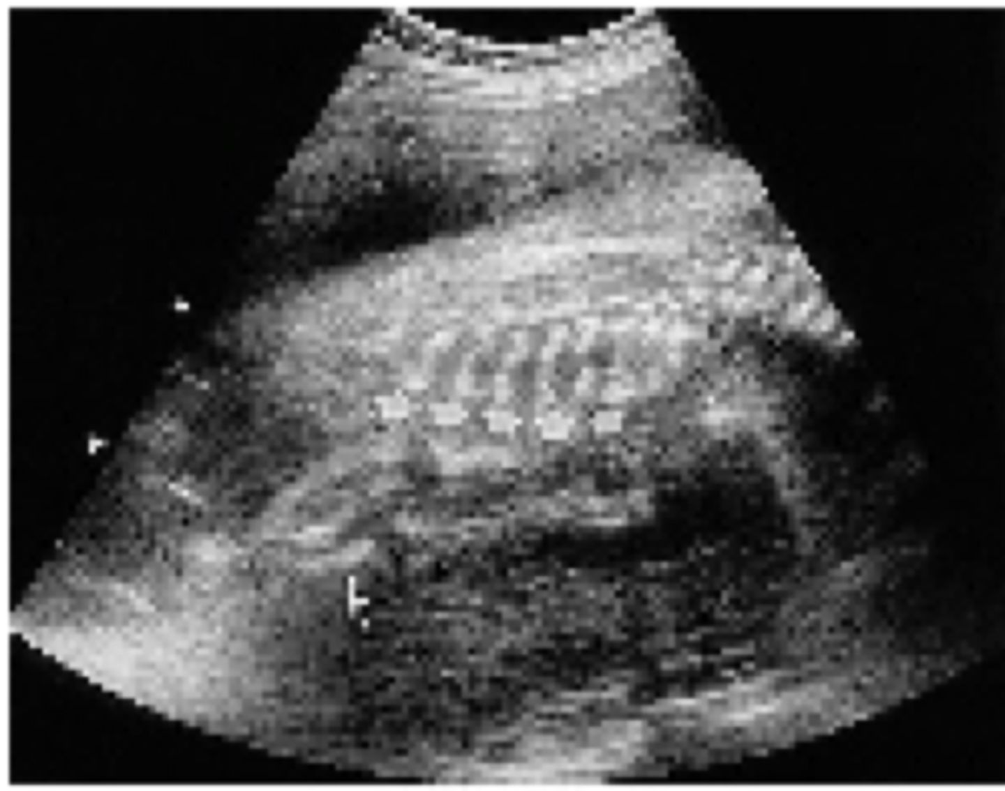 <p>A lethal condition characterized by short ribs, micromelia, and postaxial polydactyly.</p>