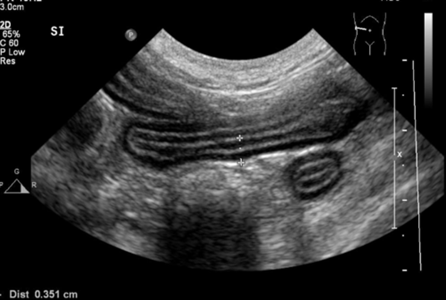 <p>is this a normal or abnormal bowel ?</p>