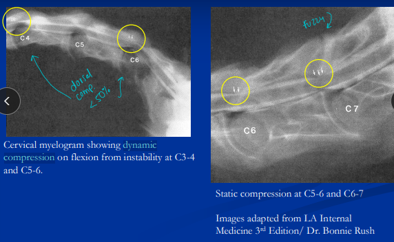 <p><span style="background-color: transparent;"><strong><span>Cervical Stenotic Myelopathy (CSM)</span></strong></span></p>