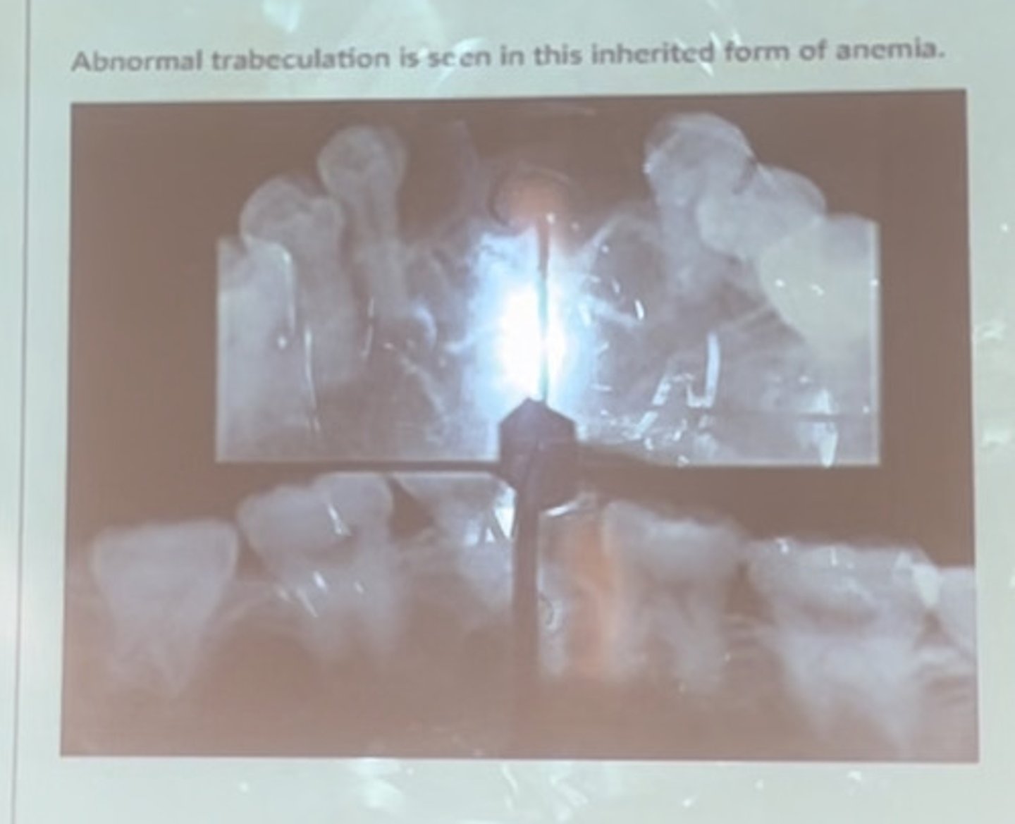 <p>Abnormal trabeculation is seen in this inherited form of anemia</p>